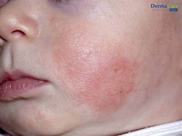 Chàm Sữa Có Tự Khỏi Không? Sự Thật Và Cách Chăm Sóc Bé