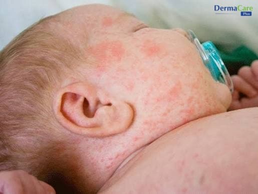 Chàm Sữa & Hăm Tã Là Gì? Nguyên Nhân, Dấu Hiệu, Cách Chăm Sóc