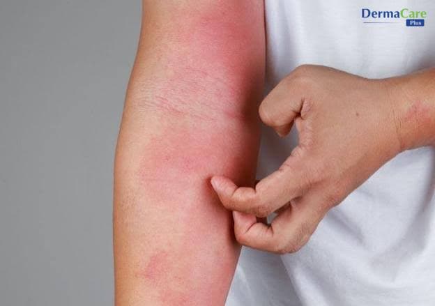 Dị Ứng Hóa Chất Là Gì? Nguyên Nhân, Dấu Hiệu Và Cách Chăm Sóc Da
