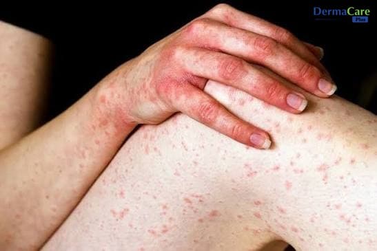Dị Ứng Hóa Chất Mãn Tính: Dấu Hiệu, Nguyên Nhân, Cách Kiểm Soát
