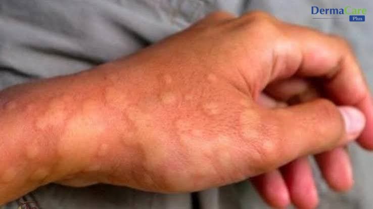 Dị Ứng Hóa Chất Ở Tay - Dấu Hiệu, Nguyên Nhân Và Cách Chăm Sóc