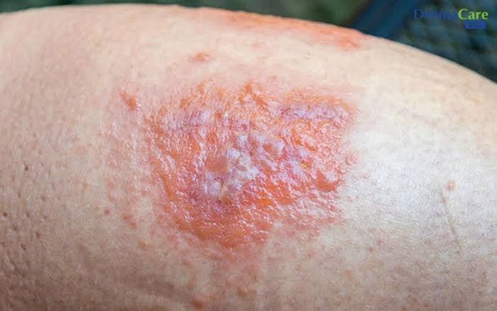 Dị Ứng Hóa Chất Tái Phát: Vì Sao Cứ Bị Lại Và Cách Phòng Ngừa