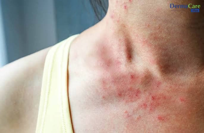 Dị Ứng Niken Là Gì? Dấu Hiệu, Nguyên Nhân Và Cách Phòng Ngừa
