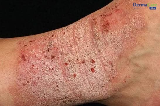 Eczema Có Lây Không? Dấu Hiệu Nhận Biết Và Cách Chăm Sóc