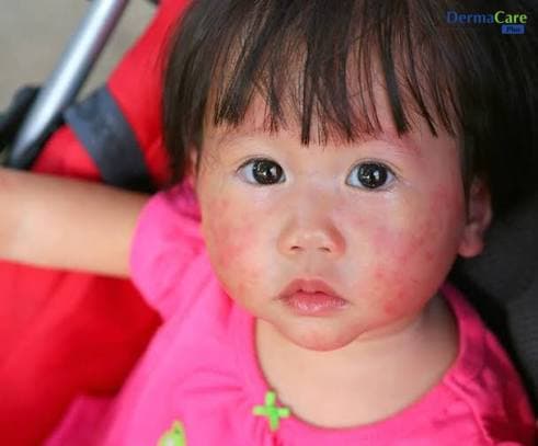 Eczema Ở Trẻ Em: Dấu Hiệu, Nguyên Nhân Và Cách Chăm Sóc Đúng