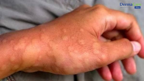 Mề Đay Do Lạnh: Dấu Hiệu, Nguyên Nhân Và Cách Phòng Ngừa