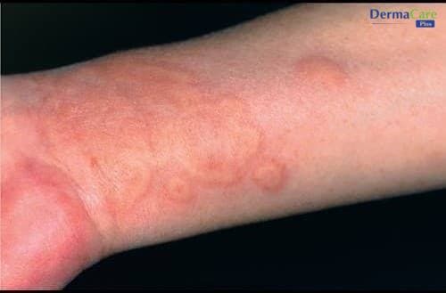 Mề Đay Do Thức Ăn: Dấu Hiệu, Nguyên Nhân, Cách Phòng Ngừa