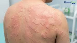 Mề Đay Phù Mạch, Sốc Phản Vệ: Dấu Hiệu Nguy Hiểm Cần Biết