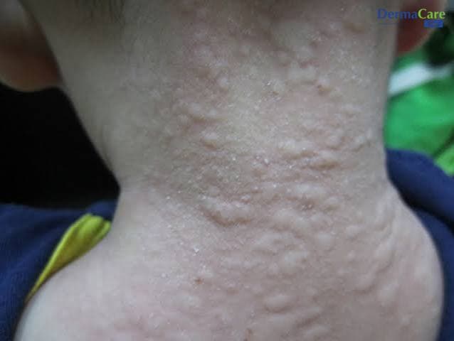 Mề Đay Ở Trẻ Em: Dấu Hiệu, Nguyên Nhân Và Cách Chăm Sóc An Toàn