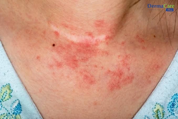 Chàm, Á Sừng, Tổ Đỉa Khác Nhau Thế Nào? Cách Nhận Biết Đơn Giản