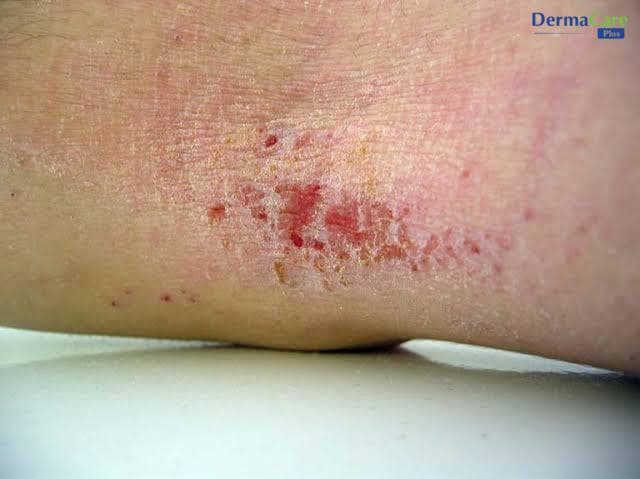 Tổ Đỉa Bội Nhiễm: Dấu Hiệu Nhận Biết, Biến Chứng Và Cách Xử Lý