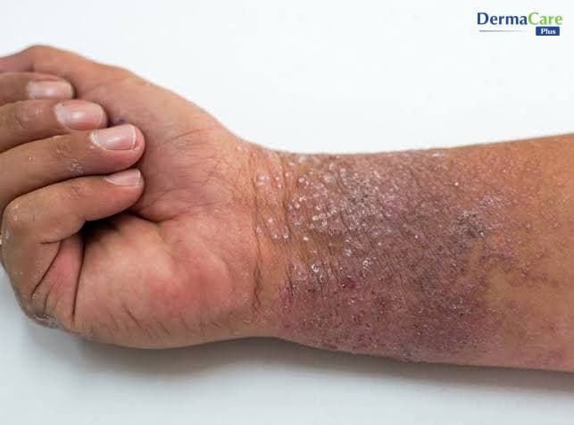 Tổ Đỉa Chọc Vỡ Mụn Nước Có Nên Không? Hậu Quả Và Cách Chăm Sóc