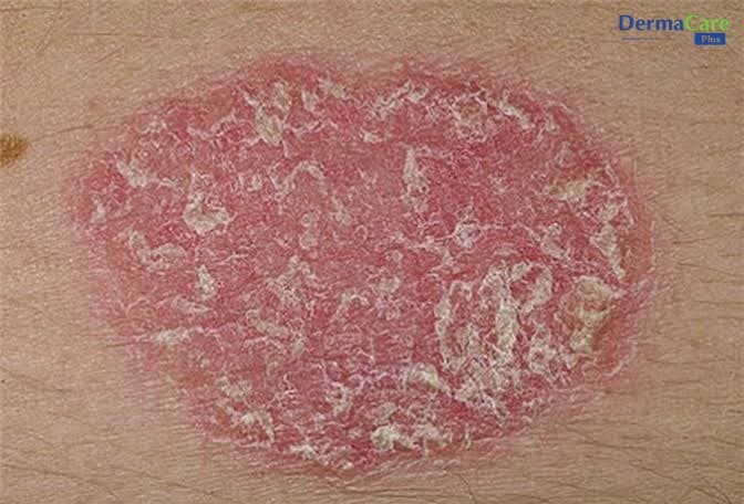 Vảy Nến Có Lây Không? Sự Thật Và Cách Chăm Sóc Da Đúng