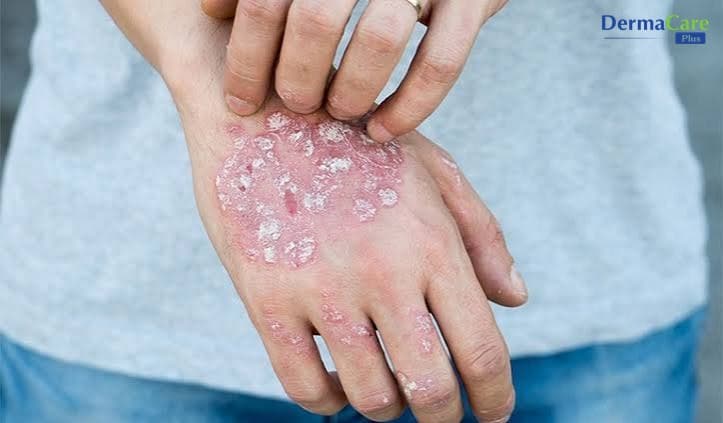 Á Sừng Và Vảy Nến Khác Nhau Thế Nào? Cách Phân Biệt, Chăm Sóc