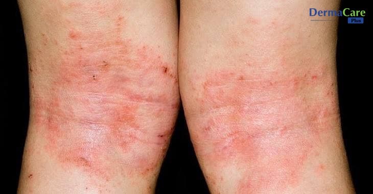 Eczema Ngứa Về Đêm: Nguyên Nhân, Biến Chứng Và Cách Xử Lý