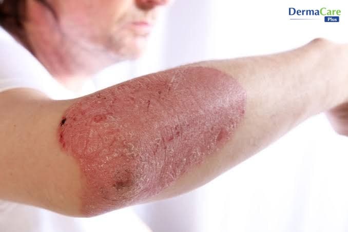 Eczema Dùng Corticoid Có Nên Không? Rủi Ro Và Cách Chăm Sóc An Toàn