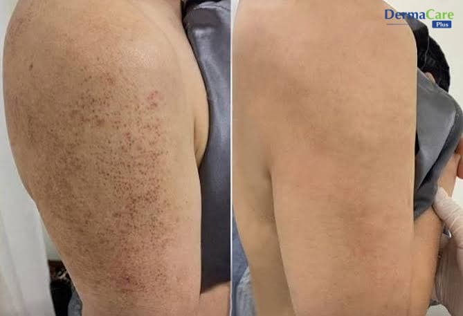 Viêm Nang Lông Để Lại Thâm: Nguyên Nhân Và Cách Khắc Phục