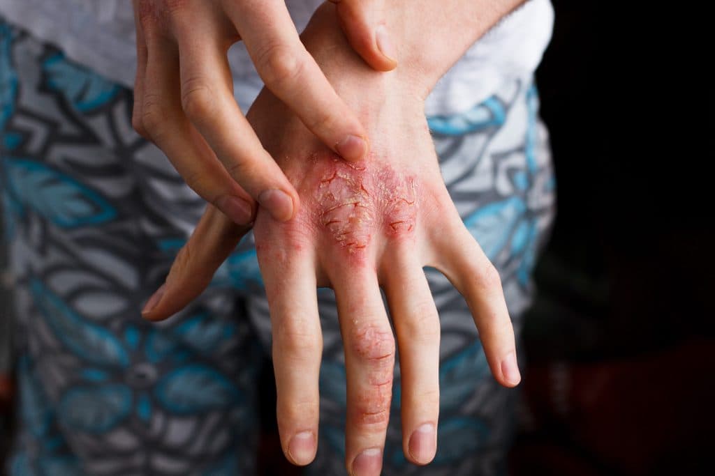 Viêm da cơ địa — Khô căng, bong tróc