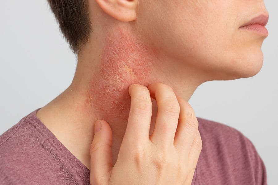Viêm da cơ địa — Ngứa rát dai dẳng
