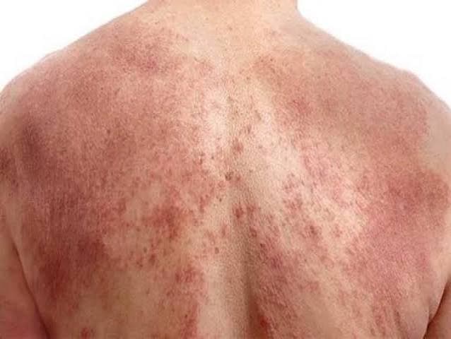 Viêm da cơ địa — Cứ tái đi tái lại