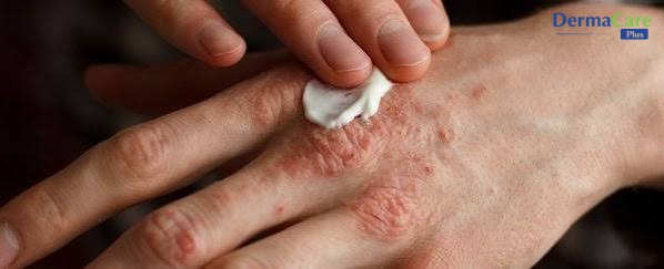 Bôi kem dưỡng ẩm lên mu bàn tay khô nứt — bước chăm sóc nên duy trì song song với chế độ ăn cân bằng