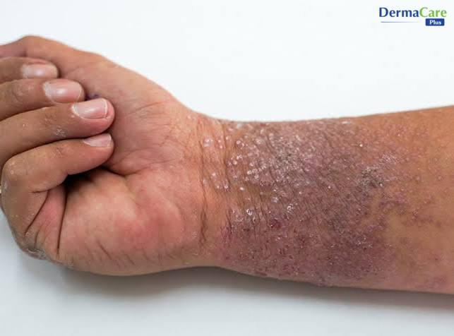 Dấu hiệu á sừng tái phát ở tay: da cổ tay khô, dày sừng và bắt đầu nứt nẻ trở lại