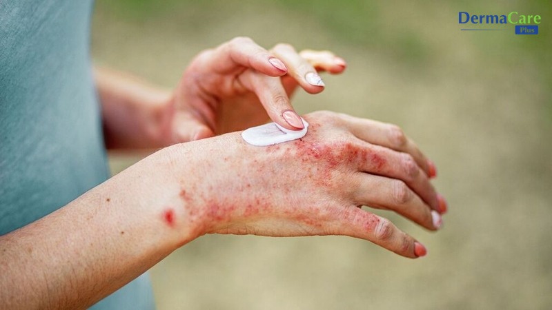 Chăm sóc da dịu nhẹ, không chứa Corticoid giúp hỗ trợ phục hồi hàng rào da giữa các đợt gàu tái phát