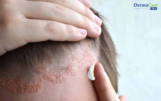 Bôi kem chăm sóc da đầu, hỗ trợ giảm ngứa và phục hồi hàng rào da tự nhiên