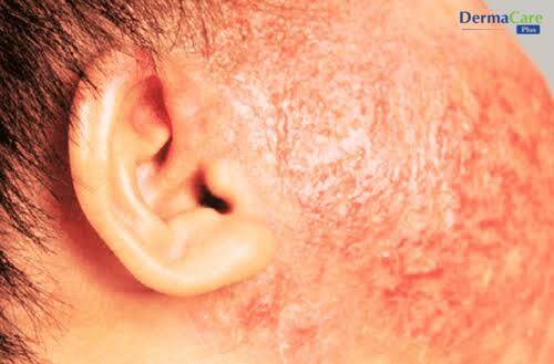 Vùng da gần chân tóc, sau tai bé đỏ ửng, khô ráp — cần phân biệt với mảng vảy vàng nhờn của cứt trâu