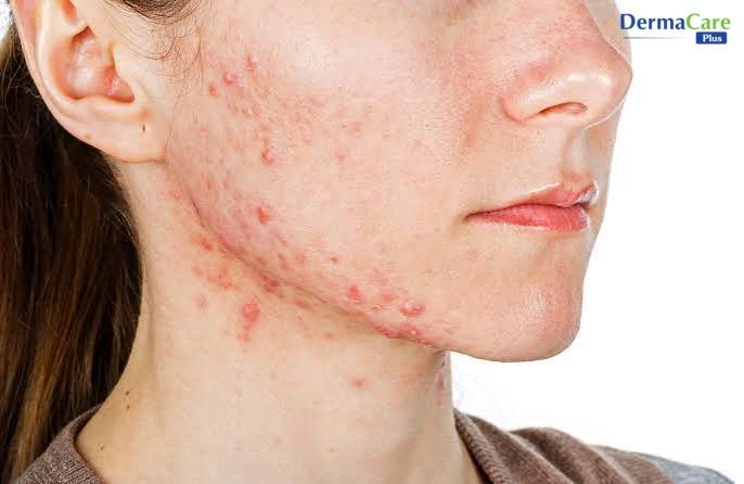 Cằm và quai hàm nổi nhiều sẩn đỏ nhỏ, mụn nước li ti — dấu hiệu dị ứng hóa chất ở mặt