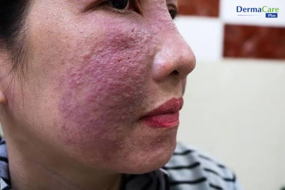 Da mặt vùng má nổi mẩn đỏ, sẩn viêm dày đặc do dị ứng hóa chất trong mỹ phẩm