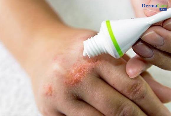 Dưỡng ẩm đều đặn mỗi ngày, kể cả khi da đã ổn, là cách phòng ngừa á sừng tái phát hiệu quả