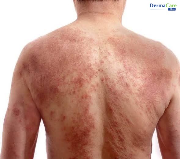 Mảng eczema đỏ lan rộng ở lưng — dấu hiệu có thể xuất hiện ở nhiều vị trí trên cơ thể, không chỉ tay chân