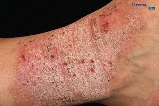 Eczema Có Lây Không? Dấu Hiệu Nhận Biết Và Cách Chăm Sóc