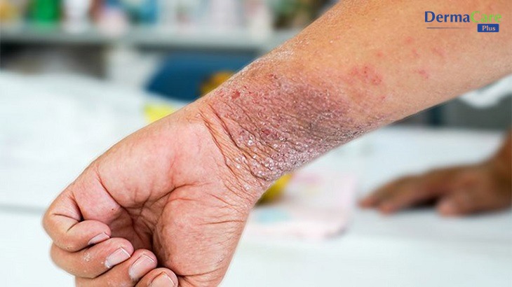 Dấu hiệu á sừng ở tay: da đầu ngón khô, đỏ, bong lớp sừng và nứt nẻ