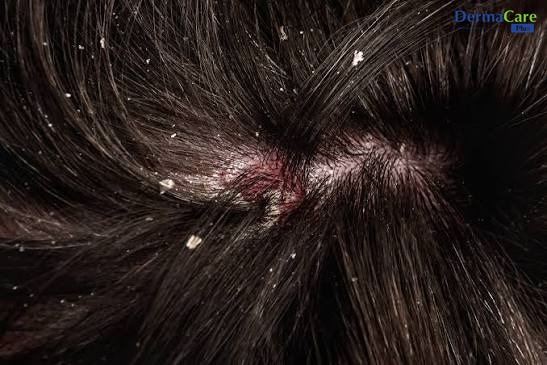Vảy gàu bám nhiều dọc chân tóc, da đầu có dấu hiệu ửng đỏ nhẹ do gãi ngứa khi căng thẳng kéo dài