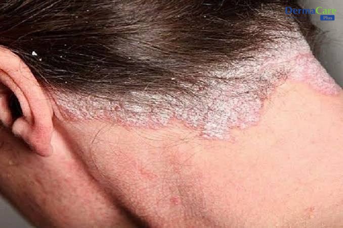 Vảy gàu lan rộng gần vùng gáy, chân tóc — dấu hiệu cần theo dõi và chăm sóc kỹ hơn khi gàu bùng phát kéo dài do stress