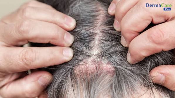 Chăm sóc da đầu đúng cách, tránh gãi mạnh giúp hỗ trợ giảm gàu và ngứa da đầu