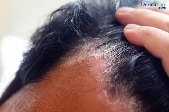 Dấu hiệu gàu da đầu tái phát: vảy trắng bám dọc chân tóc, da đầu ửng đỏ