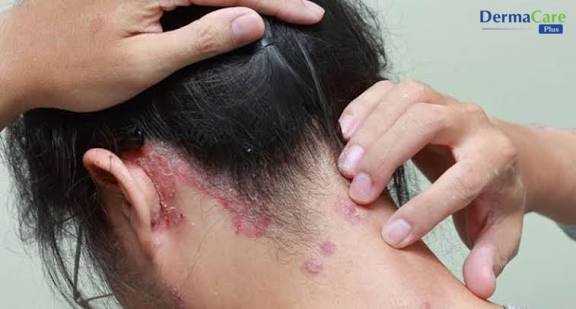Gãi nhiều khi ngứa có thể khiến da đầu, vùng gáy tổn thương và gàu dễ tái phát nặng hơn