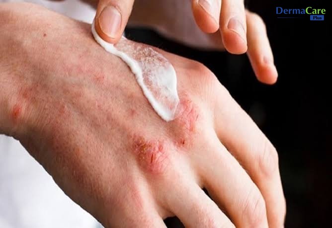 Ưu tiên sản phẩm chăm sóc da dịu nhẹ, không chứa Corticoid cho vùng da viêm da tiết bã