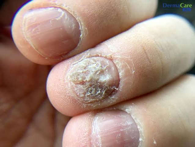 Nấm móng tay: móng vàng đục, mủn dần từ mép móng, cần phân biệt với vảy nến móng