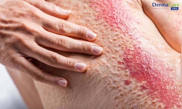 Vảy nến móng tay thường xuất hiện cùng lúc với các mảng da vảy nến ở vị trí khác