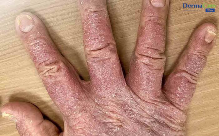 Dấu hiệu vảy nến móng tay: móng dày, rỗ chấm nhỏ và đổi màu vàng nâu