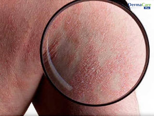 Cận cảnh mảng da vảy nến qua kính lúp — nhận biết sớm dấu hiệu bùng phát giúp chăm sóc kịp thời