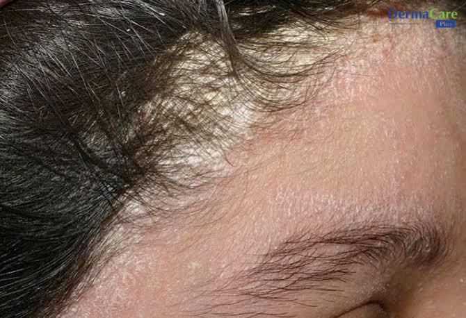 Dấu hiệu viêm da tiết bã ở trán, chân mày: da đỏ, bong vảy mịn dọc chân tóc