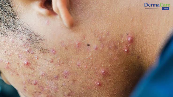 Dấu hiệu viêm nang lông ở mặt: nốt đỏ, mụn mủ nhỏ mọc quanh chân lông vùng cằm và quai hàm