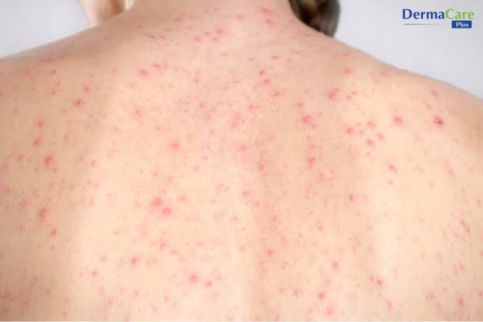 Viêm nang lông do nấm men Malassezia ở lưng trên: nốt nhỏ đồng đều, mọc thành đám dày đặc