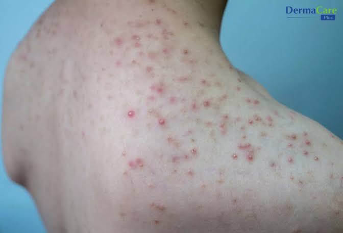Viêm nang lông do vi khuẩn ở vùng vai, lưng: các nốt viêm không đều kích thước, có mủ