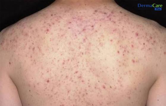 Viêm Nang Lông Là Gì? Nguyên Nhân, Dấu Hiệu Và Cách Chăm Sóc Da